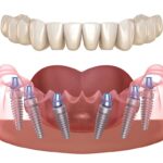 Implantes dentales en Madrid: Recupera tu sonrisa y funcionalidad oral.