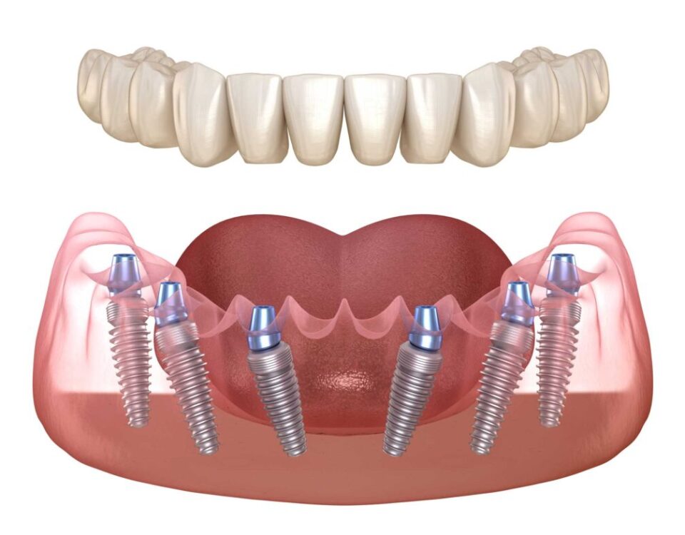Implantes dentales en Madrid: Recupera tu sonrisa y funcionalidad oral.