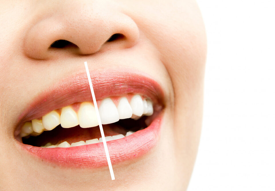 Blanqueamiento dental en Madrid: ¡Consigue una sonrisa blanca!